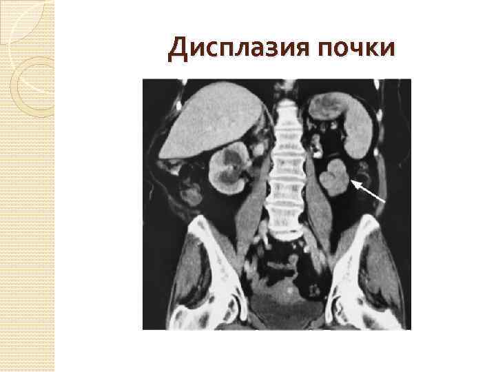 Дисплазия почки 
