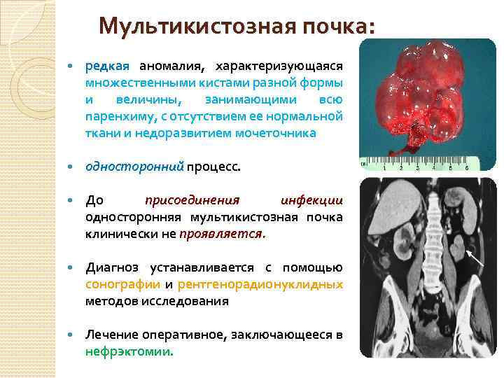 Мультикистозная почка: редкая аномалия, характеризующаяся множественными кистами разной формы и величины, занимающими всю паренхиму,