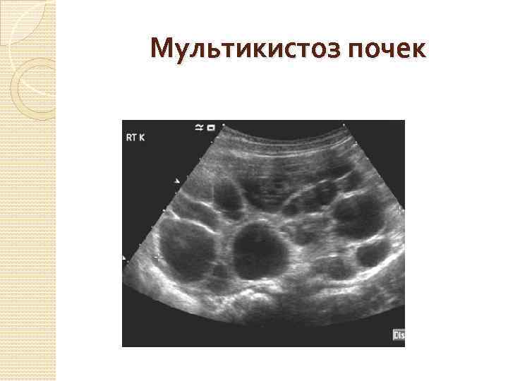 Мультикистоз почек 