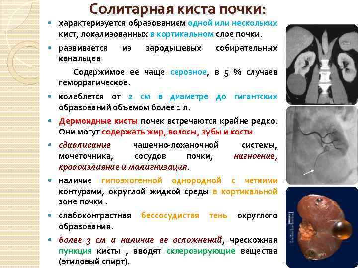 Солитарная киста почки: характеризуется образованием одной или нескольких кист, локализованных в кортикальном слое почки.