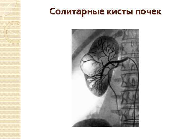 Солитарные кисты почек 