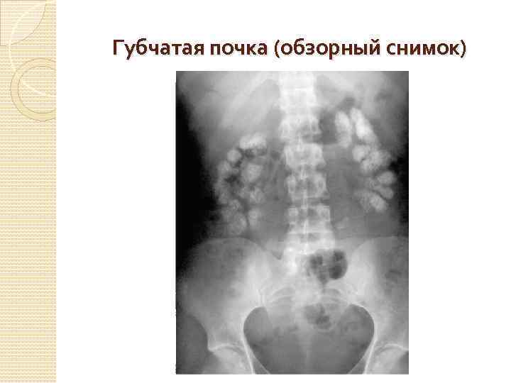 Губчатая почка (обзорный снимок) 