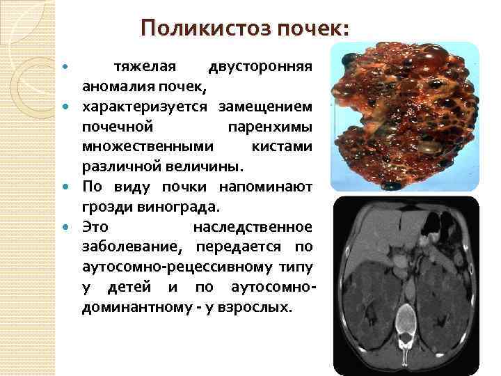 Поликистоз почек: тяжелая двусторонняя аномалия почек, характеризуется замещением почечной паренхимы множественными кистами различной величины.