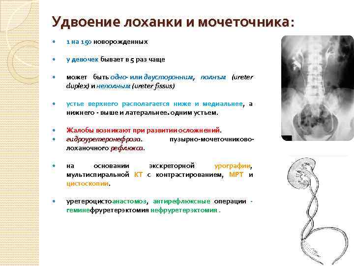 Удвоение лоханки и мочеточника: 1 на 150 новорожденных у девочек бывает в 5 раз