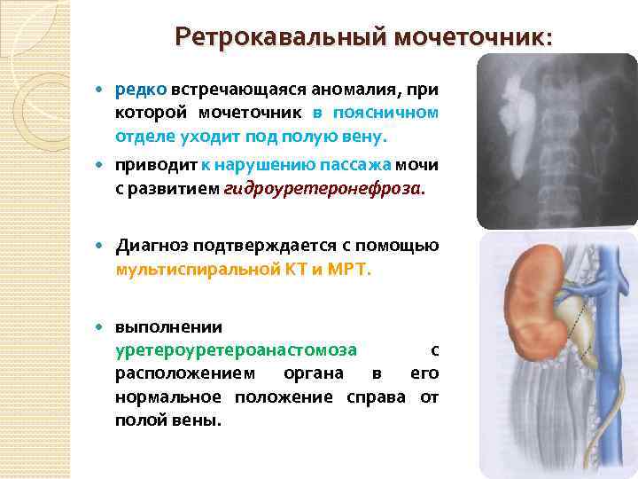 Ретрокавальный мочеточник: редко встречающаяся аномалия, при которой мочеточник в поясничном отделе уходит под полую