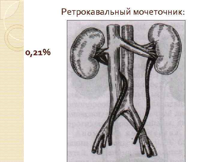 Ретрокавальный мочеточник: 0, 21% 