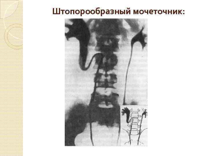 Штопорообразный мочеточник: 