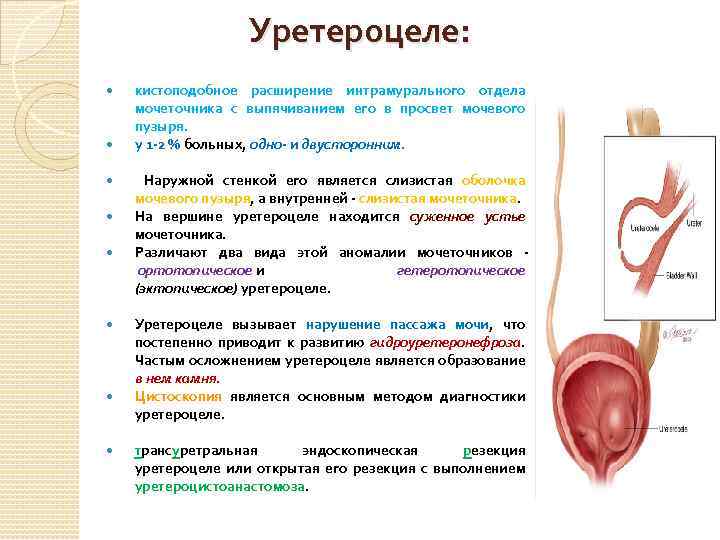 Уретероцеле: кистоподобное расширение интрамурального отдела мочеточника с выпячиванием его в просвет мочевого пузыря. у