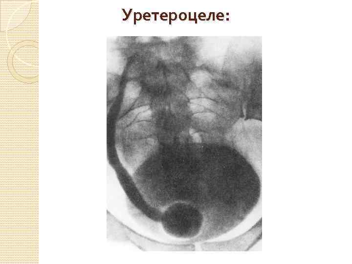 Уретероцеле: 