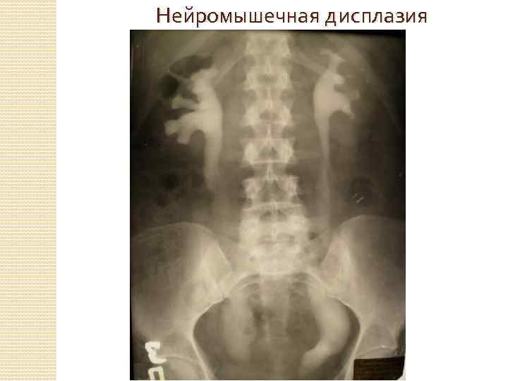 Нейромышечная дисплазия 