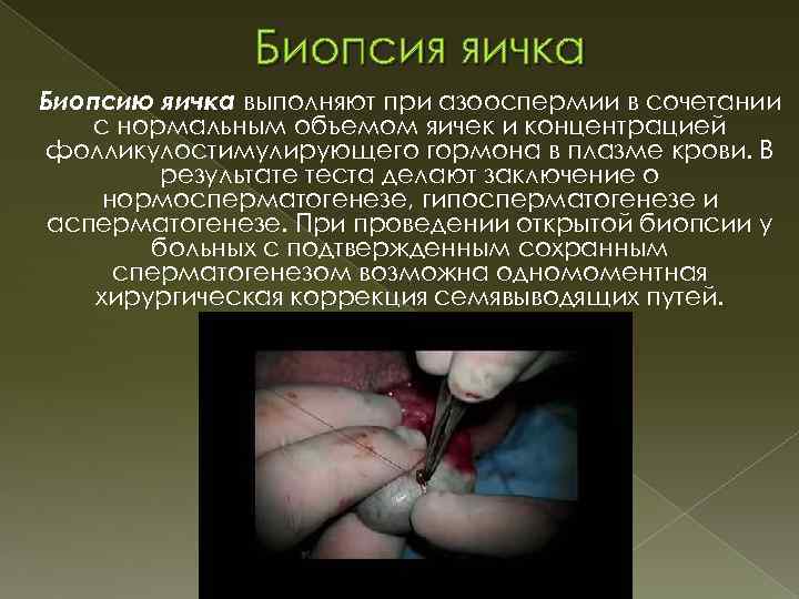 Биопсия яичка Биопсию яичка выполняют при азооспермии в сочетании с нормальным объемом яичек и
