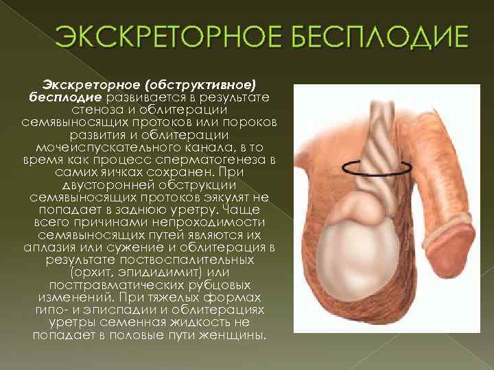 ЭКСКРЕТОРНОЕ БЕСПЛОДИЕ Экскреторное (обструктивное) бесплодие развивается в результате стеноза и облитерации семявыносящих протоков или
