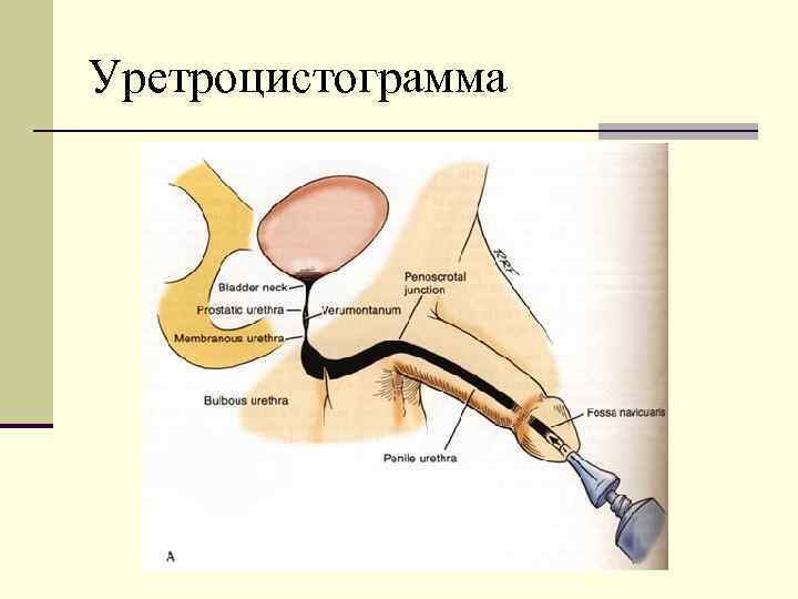 Уретроцистограмма 