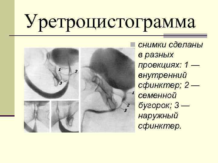 Уретроцистограмма n снимки сделаны в разных проекциях: 1 — внутренний сфинктер; 2 — семенной