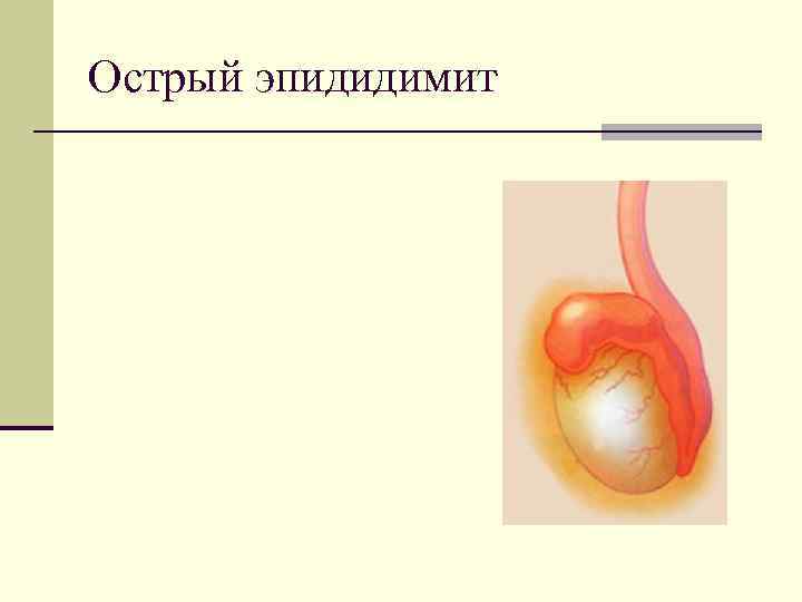 Острый эпидидимит 