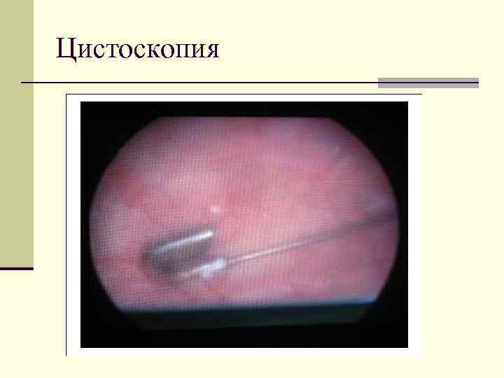 Цистоскопия 
