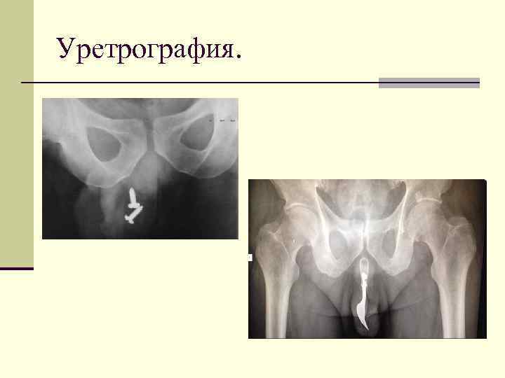 Уретрография. 