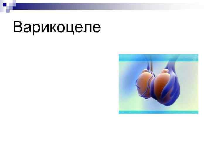 Варикоцеле 
