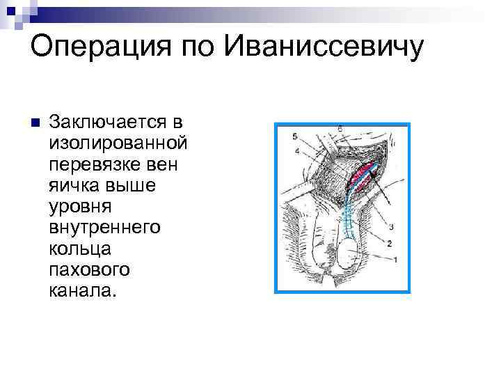 Операция по Иваниссевичу n Заключается в изолированной перевязке вен яичка выше уровня внутреннего кольца