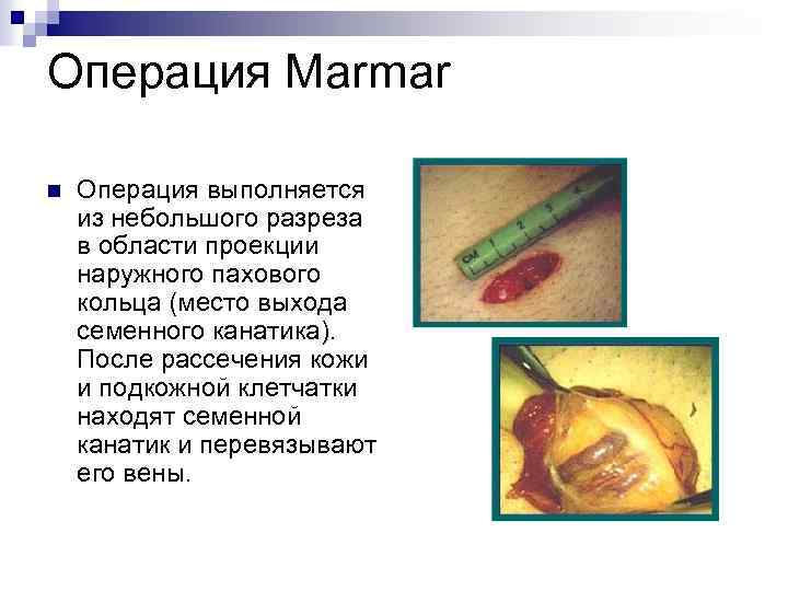 Операция Marmar n Операция выполняется из небольшого разреза в области проекции наружного пахового кольца