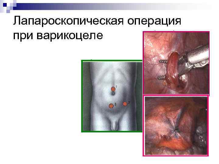 Лапароскопическая операция при варикоцеле 