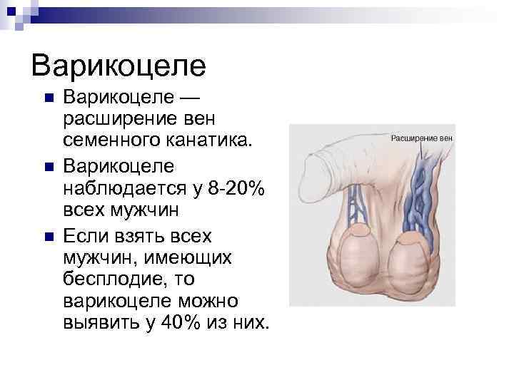 Варикоцеле n n n Варикоцеле — расширение вен семенного канатика. Варикоцеле наблюдается у 8