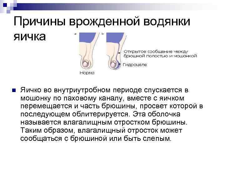 Причины врожденной водянки яичка n Яичко во внутриутробном периоде спускается в мошонку по паховому