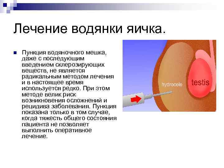 Лечение водянки яичка. n Пункция водяночного мешка, даже с последующим введением склерозирующих веществ, не
