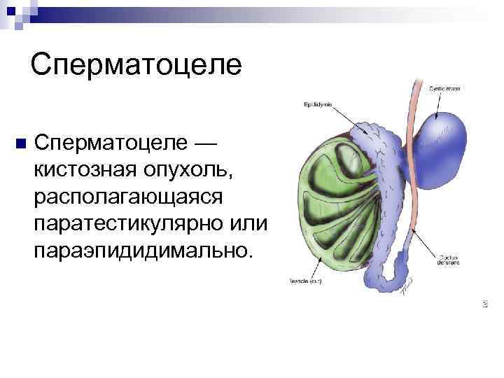 Сперматоцеле n Сперматоцеле — кистозная опухоль, располагающаяся паратестикулярно или параэпидидимально. 