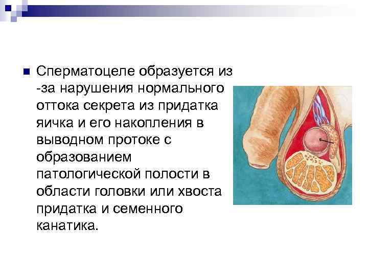 n Сперматоцеле образуется из -за нарушения нормального оттока секрета из придатка яичка и его