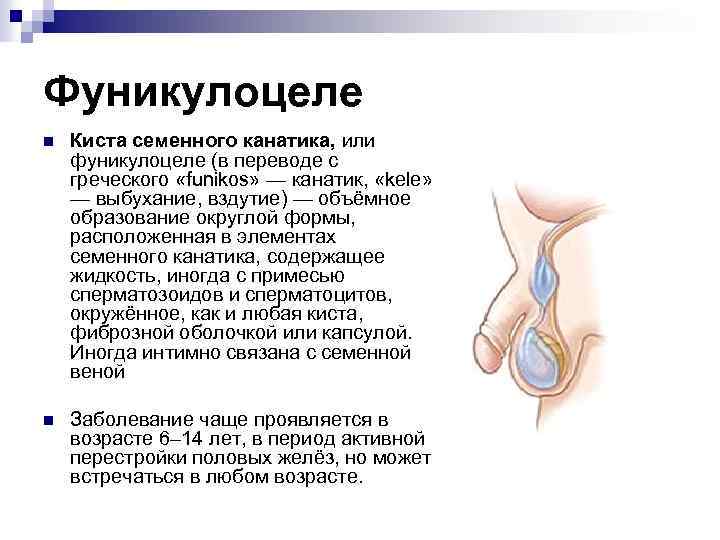 Фуникулоцеле n Киста семенного канатика, или фуникулоцеле (в переводе с греческого «funikos» — канатик,