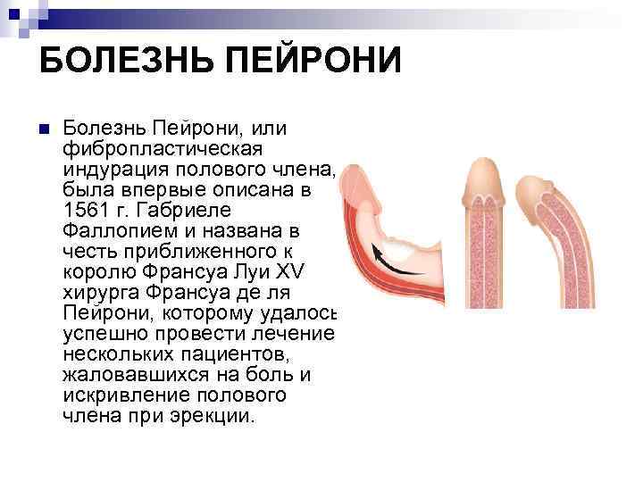 БОЛЕЗНЬ ПЕЙРОНИ n Болезнь Пейрони, или фибропластическая индурация полового члена, была впервые описана в