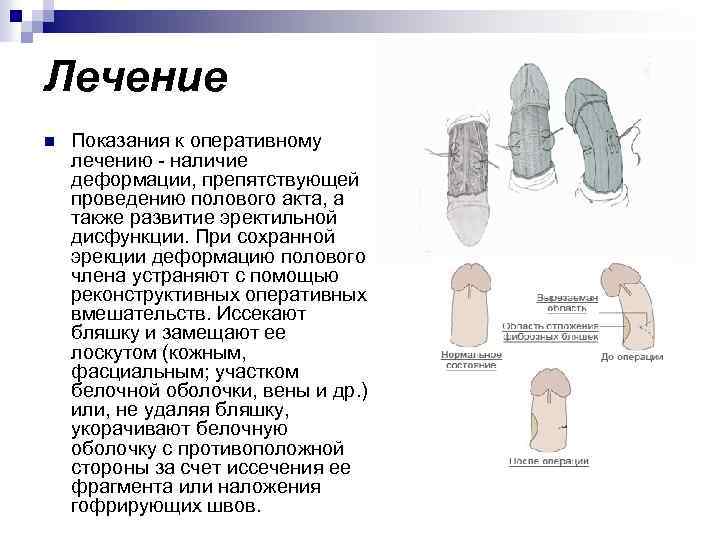 Лечение n Показания к оперативному лечению - наличие деформации, препятствующей проведению полового акта, а
