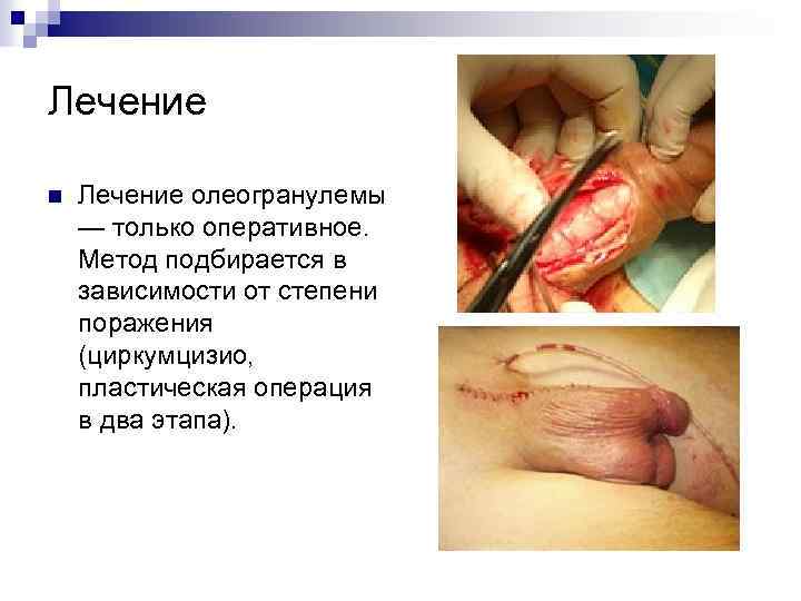 Лечение n Лечение олеогранулемы — только оперативное. Метод подбирается в зависимости от степени поражения