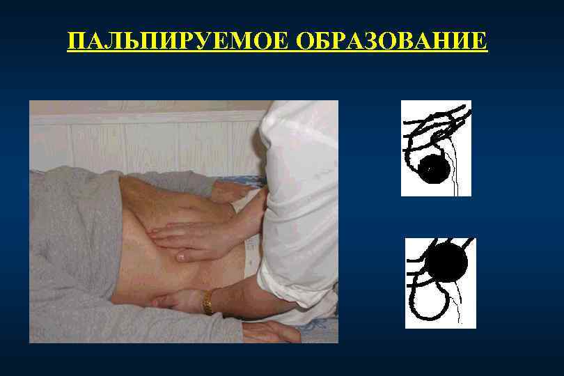 ПАЛЬПИРУЕМОЕ ОБРАЗОВАНИЕ 