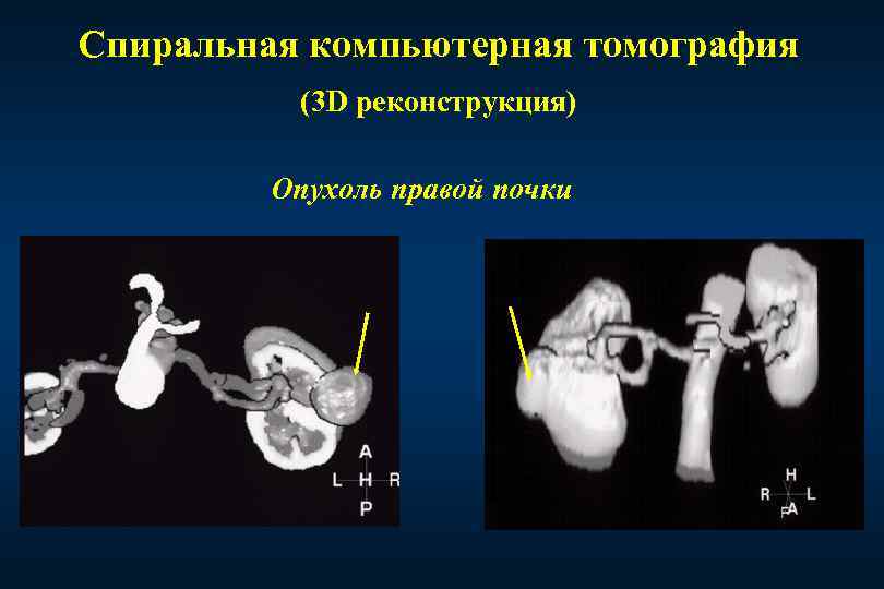 Спиральная компьютерная томография (3 D реконструкция) Опухоль правой почки 