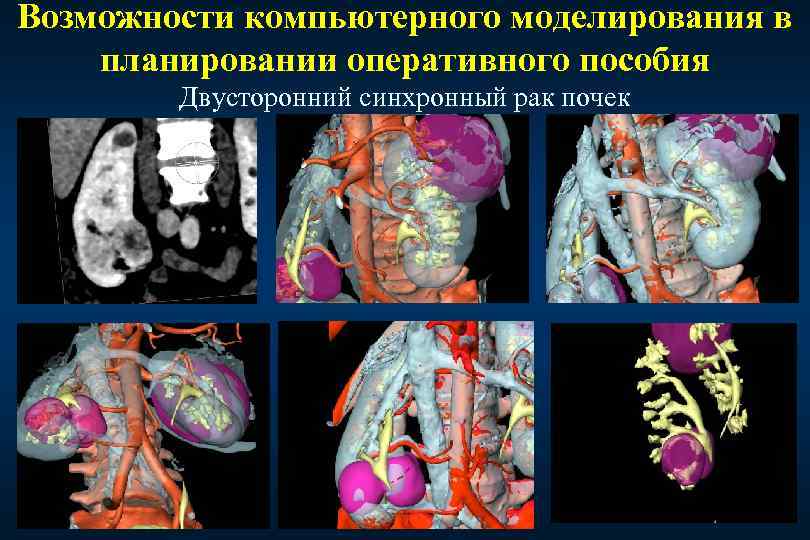 Возможности компьютерного моделирования в планировании оперативного пособия Двусторонний синхронный рак почек 