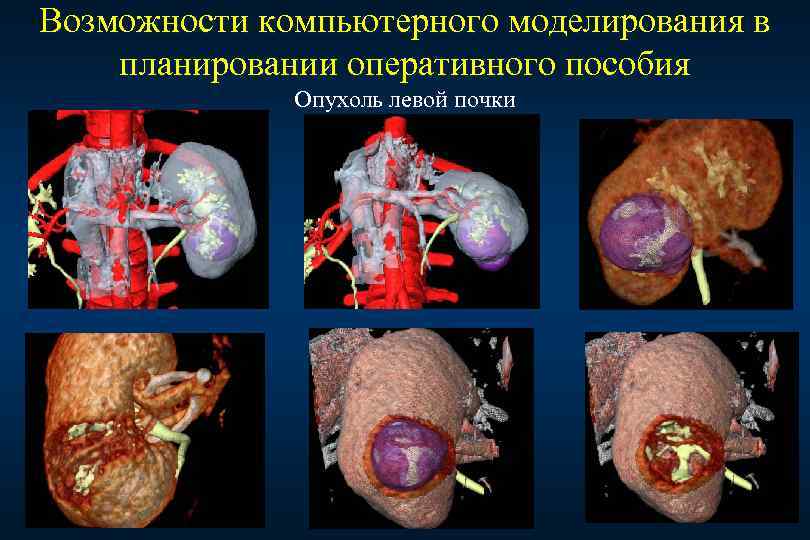 Как выглядит опухоль на почке фото