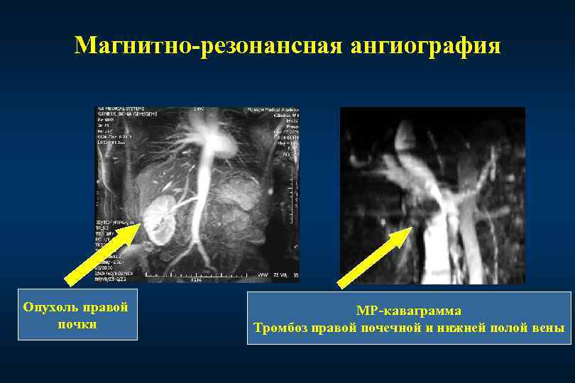 Опухоль почечной лоханки презентация