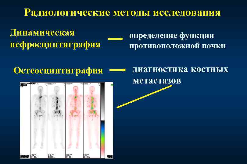 Радиологические методы исследования Динамическая нефросцинтиграфия Остеосцинтиграфия определение функции противоположной почки диагностика костных метастазов 