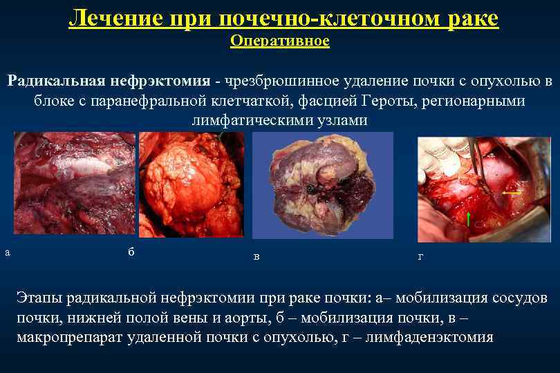Лечение при почечно-клеточном раке Оперативное Радикальная нефрэктомия - чрезбрюшинное удаление почки с опухолью в