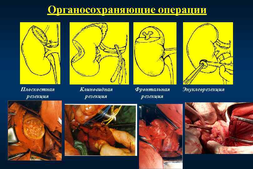 Органосохраняющие операции Плоскостная резекция Клиновидная резекция Фронтальная резекция Энуклеорезекция 