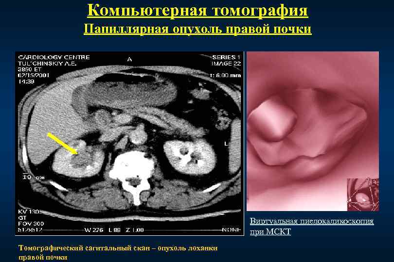 Как выглядит опухоль на почке фото