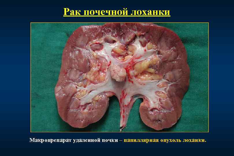Рак почечной лоханки Макропрепарат удаленной почки – папиллярная опухоль лоханки. 