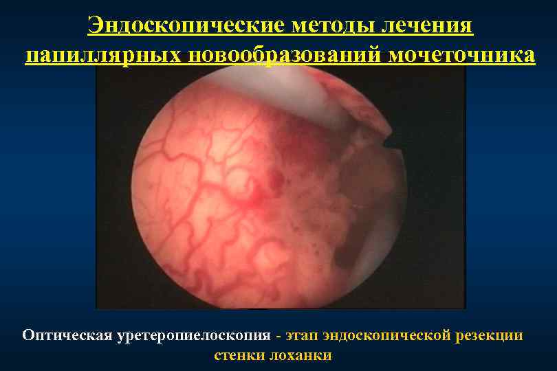 Эндоскопические методы лечения папиллярных новообразований мочеточника Оптическая уретеропиелоскопия - этап эндоскопической резекции стенки лоханки