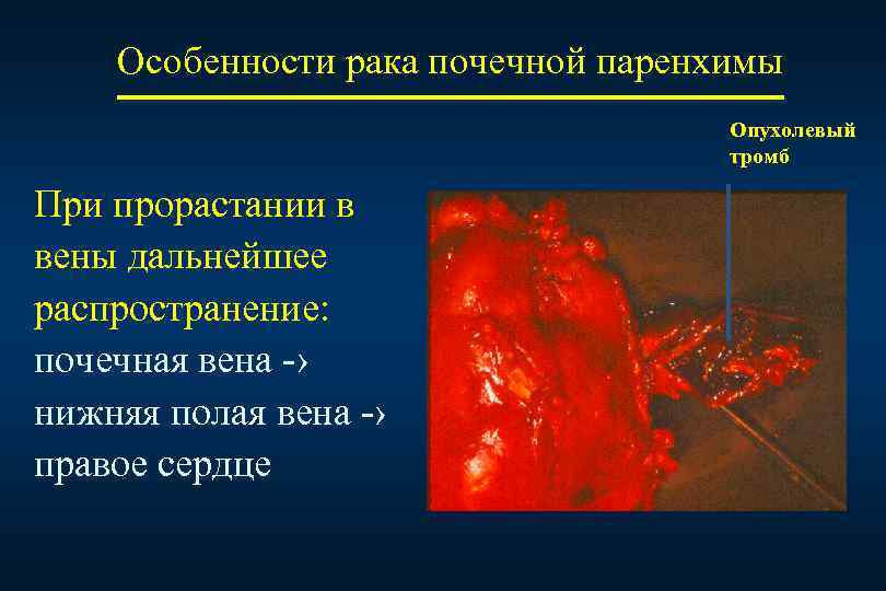 Особенности рака почечной паренхимы Опухолевый тромб При прорастании в вены дальнейшее распространение: почечная вена