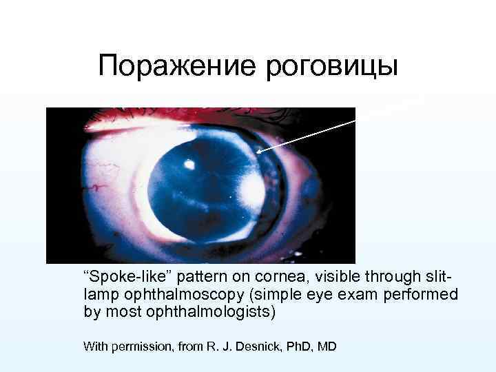 Поражение роговицы “Spoke-like” pattern on cornea, visible through slitlamp ophthalmoscopy (simple eye exam performed