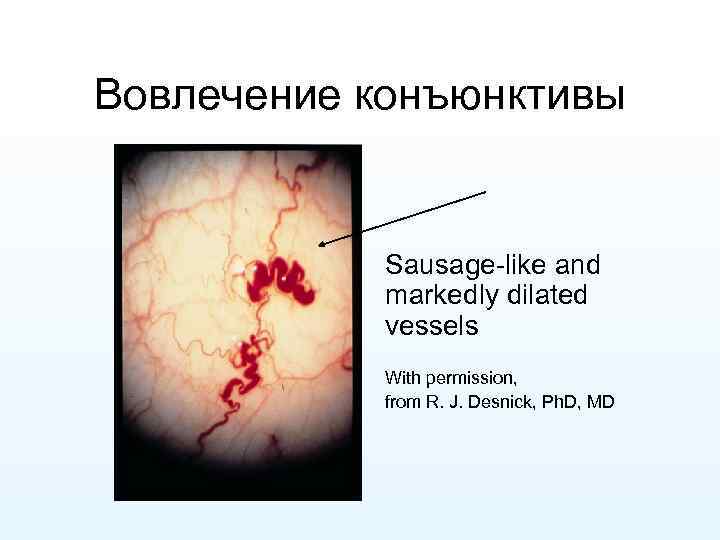 Вовлечение конъюнктивы Sausage-like and markedly dilated vessels With permission, from R. J. Desnick, Ph.