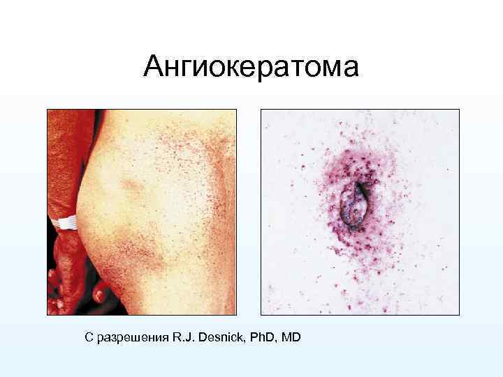 Ангиокератома С разрешения R. J. Desnick, Ph. D, MD 