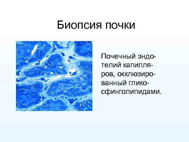 Биопсия почки Почечный эндотелий капилляров, окклюзированный гликосфинголипидами. 